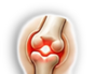 Arthritis